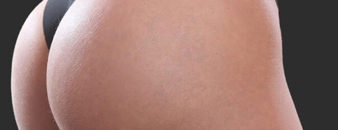 butt lift results